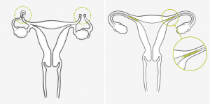 женская стерилизация