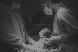 кесарево сечение